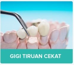 Gigi Tiruan Cekat Crown Bridge Malang